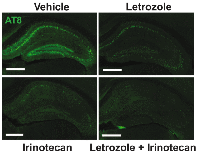 Certain Cancer Drugs May Reverse Brain Changes That Occur During Alzheimer's